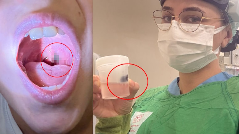 Burun kanamasıyla hastaneye gitti, boğazından çıkan şey doktorları bile şaşırttı - Görsel 1