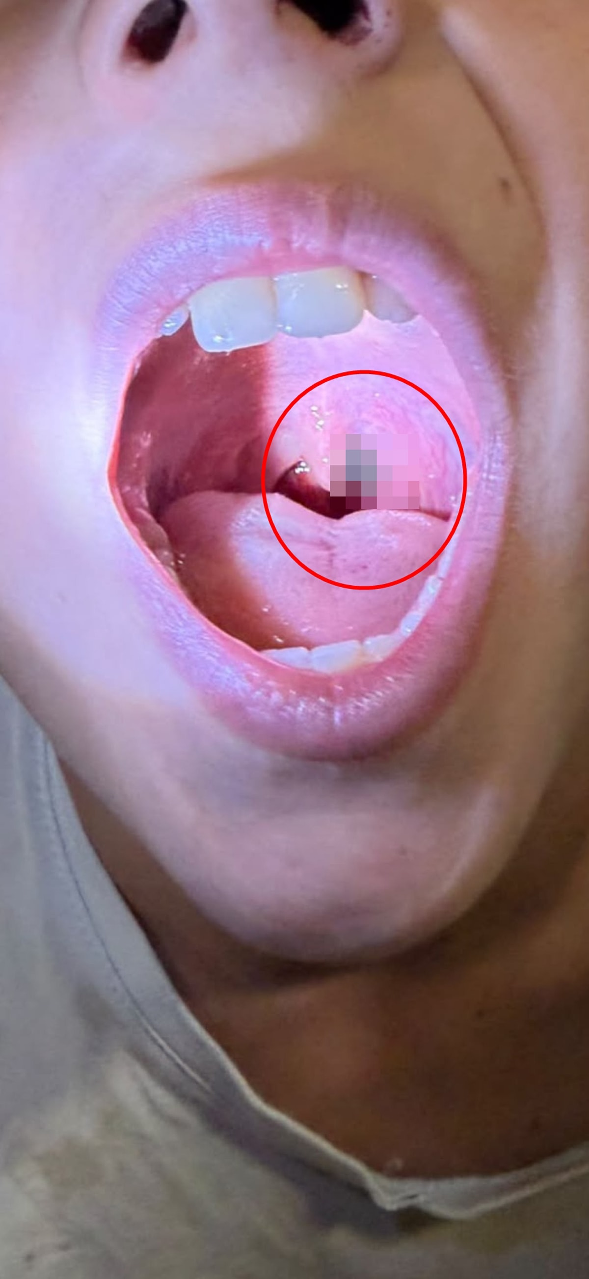 Burun kanamasıyla hastaneye gitti, boğazından çıkan şey doktorları bile şaşırttı - Görsel 2