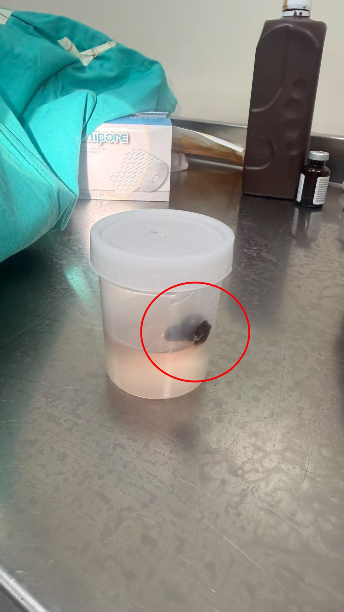 Burun kanamasıyla hastaneye gitti, boğazından çıkan şey doktorları bile şaşırttı - Görsel 3