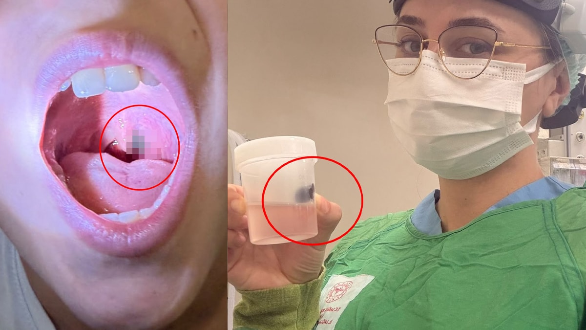 Burun kanamasıyla hastaneye gitti, boğazından çıkan şey doktorları bile şaşırttı